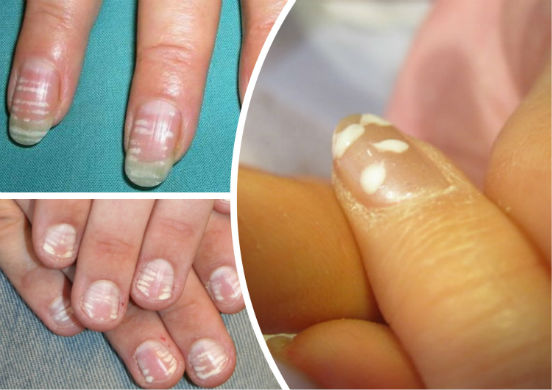 Почему возникают белые пятна на ногтях и как излечится от необычного недуга?