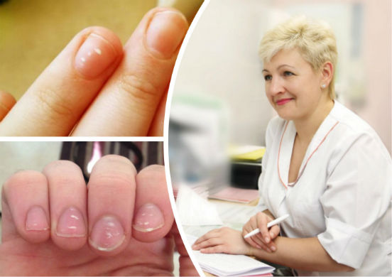 Почему возникают белые пятна на ногтях и как излечится от необычного недуга?